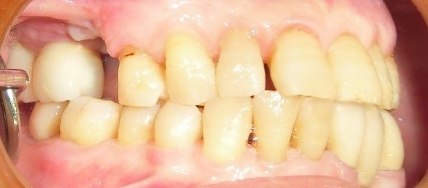 歯周形成外科治療 before