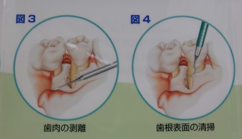 歯周組織再生療法（エムドゲイン療法、骨補填剤使用）01