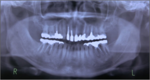 前歯部審美修復