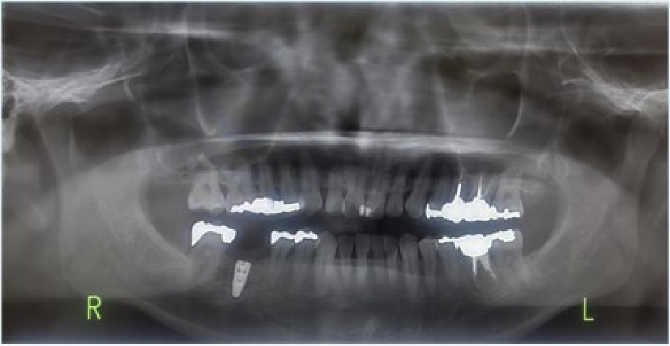 下顎臼歯部GBR症例