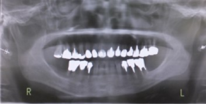 下顎臼歯部
