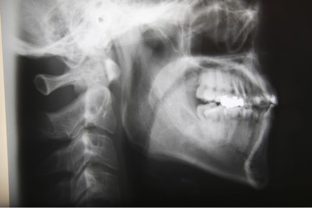顎関節部分のレントゲン撮影