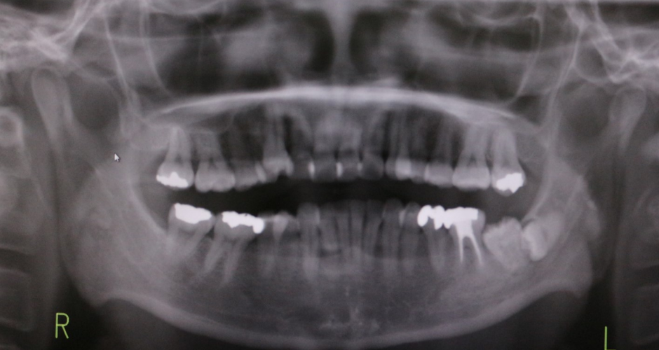 インプラントアンカーによる大臼歯の圧下