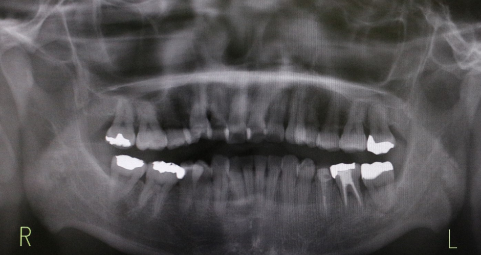 インプラントアンカーによる大臼歯の圧下