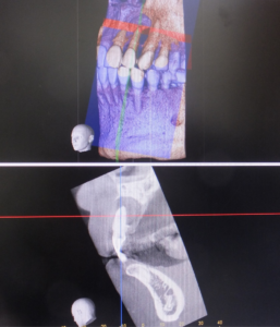 歯根嚢胞(のうほう)の摘出CT